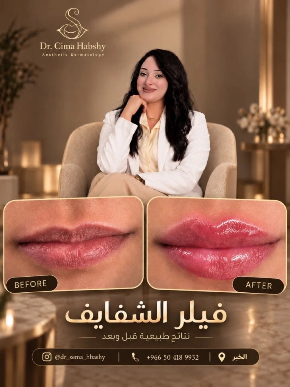 د. سيما — فيلر الشفايف