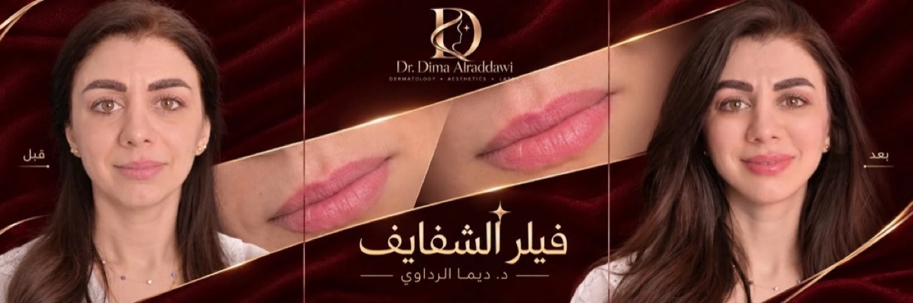 د. ديما — فيلر الشفايف