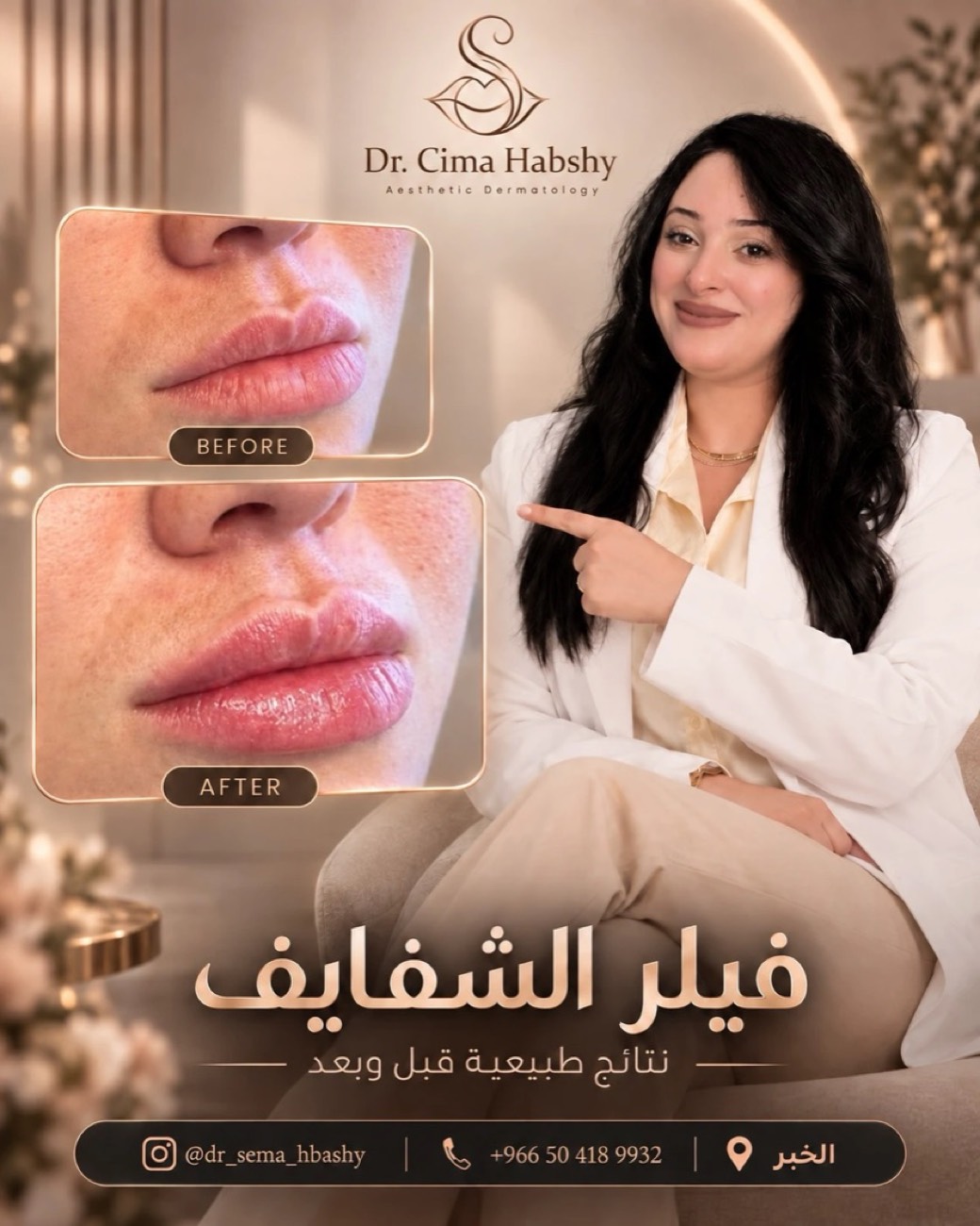 د. سيما — فيلر الشفايف